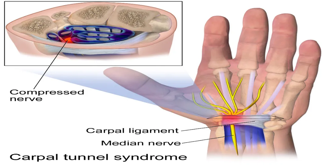 1. Carpal Tunnel Syndrome and its Common Misdiagnosis - Main