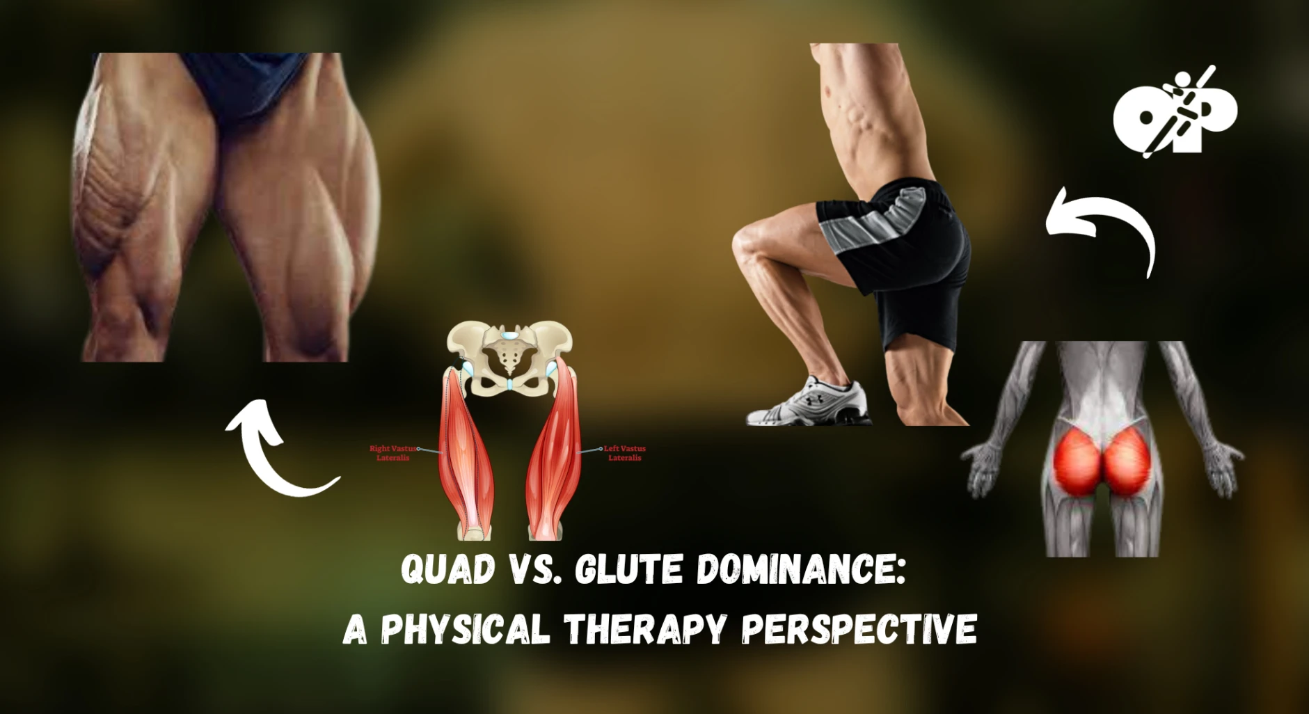 34. Quad vs. Glute Dominance – A Physical Therapy Perspective