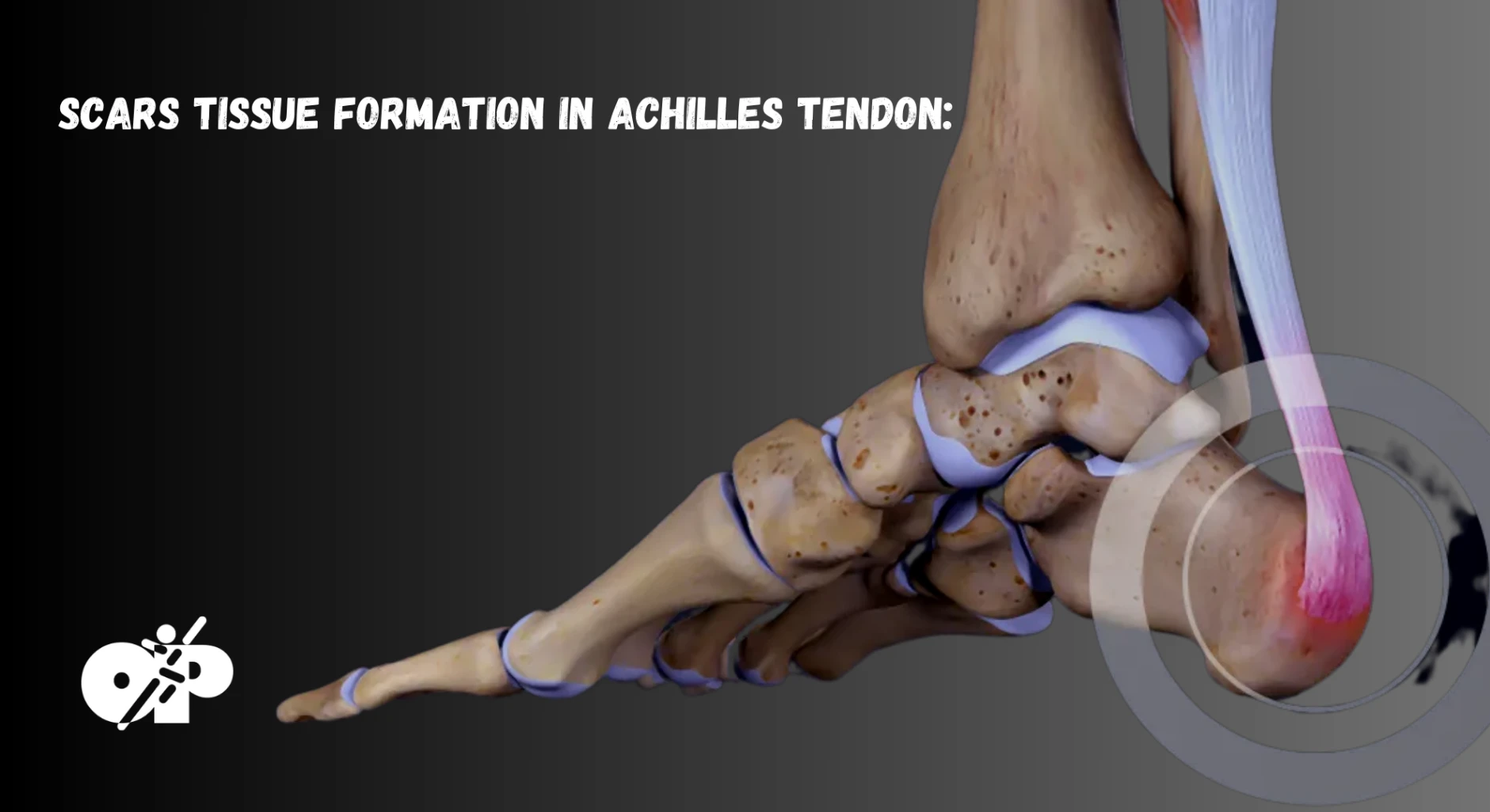 36. Scars tissue Formation in Achilles Tendon – Physiotherapy